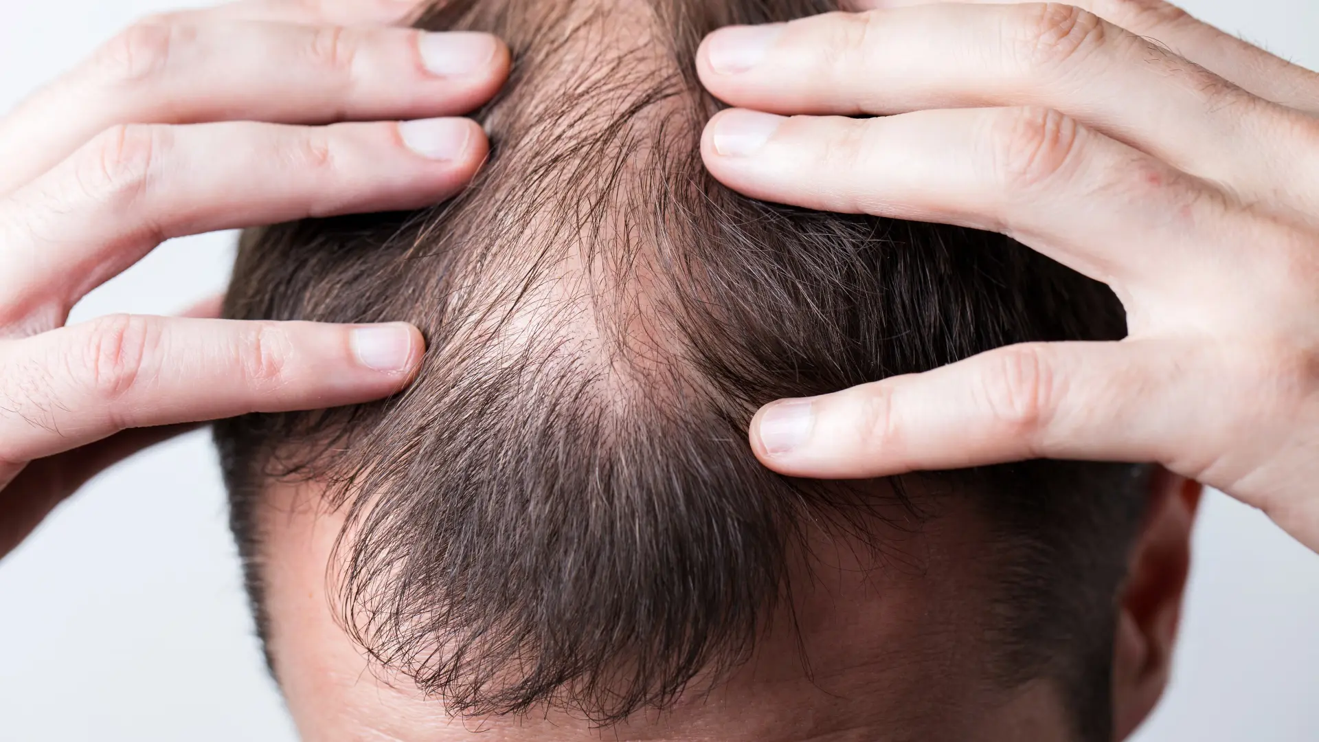 ¿Estoy Quedándome Calvo? Cómo Detectar la Caída del Cabello a Tiempo